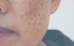 Hyperpigmentation treatments at Intermezzo Salon & Spa in Seattle