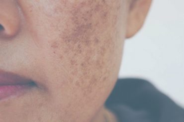 Hyperpigmentation treatments at Intermezzo Salon & Spa in Seattle