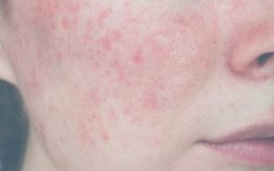 Treatments for rosacea at Intermezzo Salon & Spa in Seattle