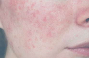 Treatments for rosacea at Intermezzo Salon & Spa in Seattle